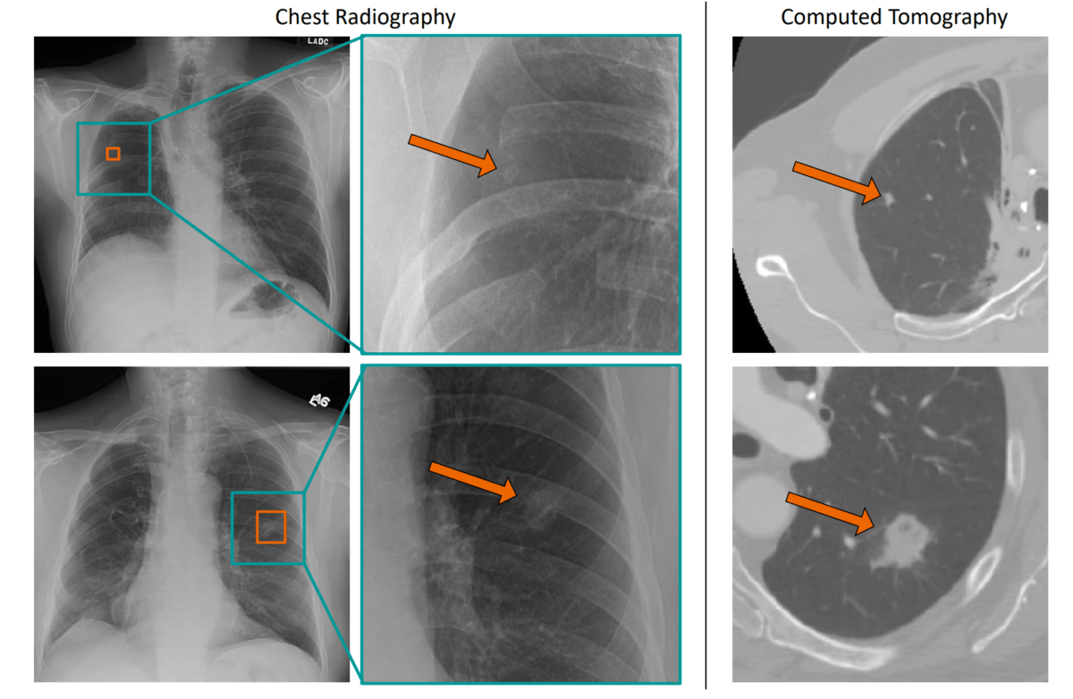 Röntgenaufnahmen des Brustkorbs mit Markierungen verdächtiger Knoten in der Lunge