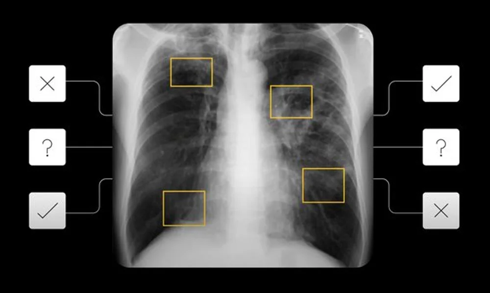 Auf Arzt-Niveau: Google bekämpft Tuberkulose mit KI