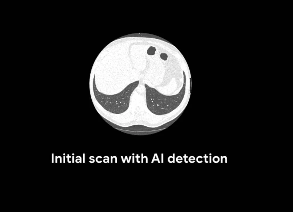 Google-KI schlägt Radiologen bei Lungenkrebsdiagnose
