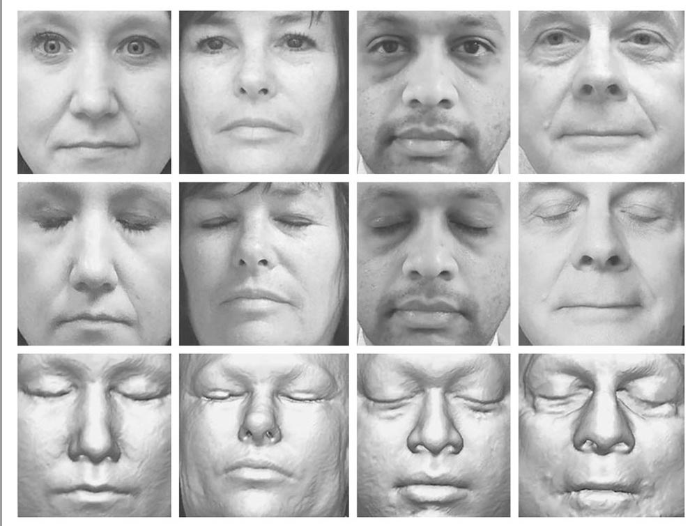 Die Gesichter unten sind digitale Rekonstruktionen anhand eines MRT-Scans. Die Bilder oben sind Originalfotos, denen sie zugeordnet werden konnten. Bild: Mayo Clinic, via the New England Journal of Medicine